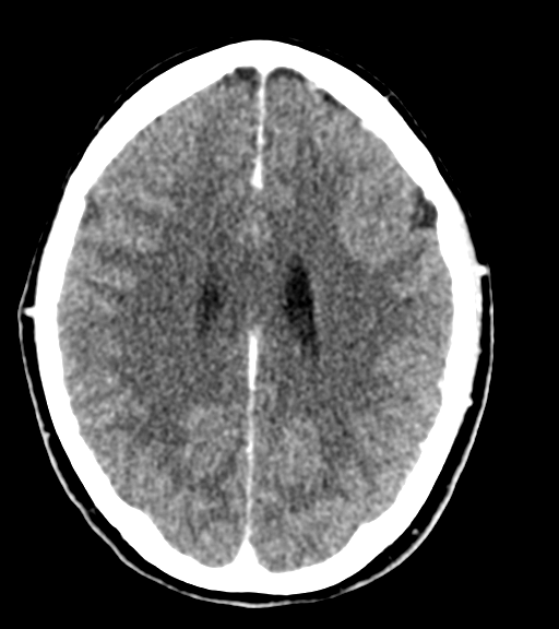 Cerebellar metastases - colorectal adenocarcinoma (Radiopaedia 40947-43652 Axial C+ 40).png