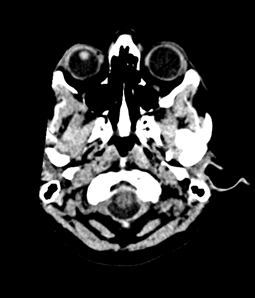 File:Cerebellar metastases - colorectal adenocarcinoma (Radiopaedia 40947-43652 Axial non-contrast 4).png
