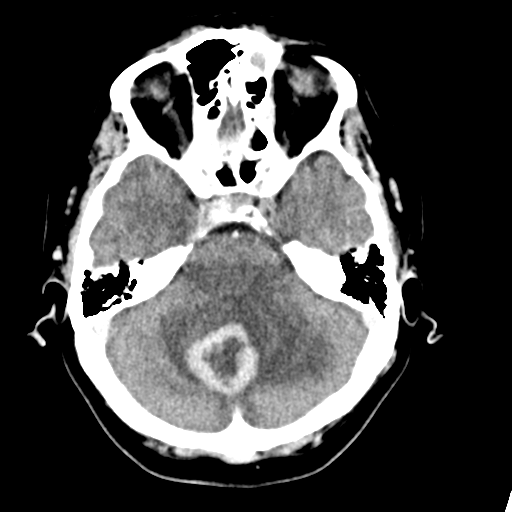 File:Cerebellar metastasis (Radiopaedia 54578-60812 Axial C+ 14).png