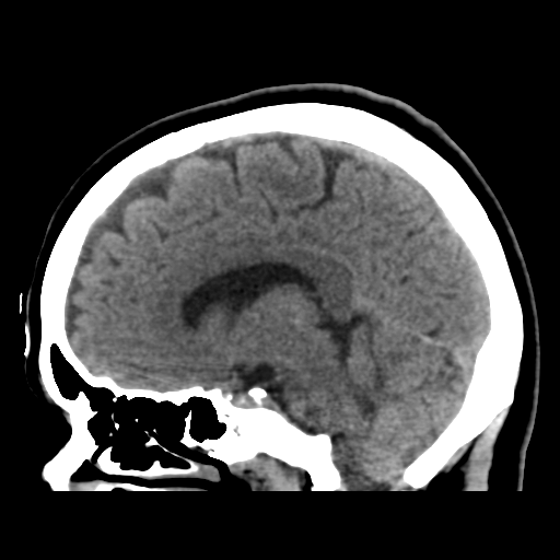 Cerebellar metastasis (cystic appearance) (Radiopaedia 41395-44258 E 27).png