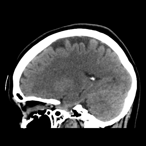 File:Cerebellar metastasis (cystic appearance) (Radiopaedia 41395-44258 E 36).png