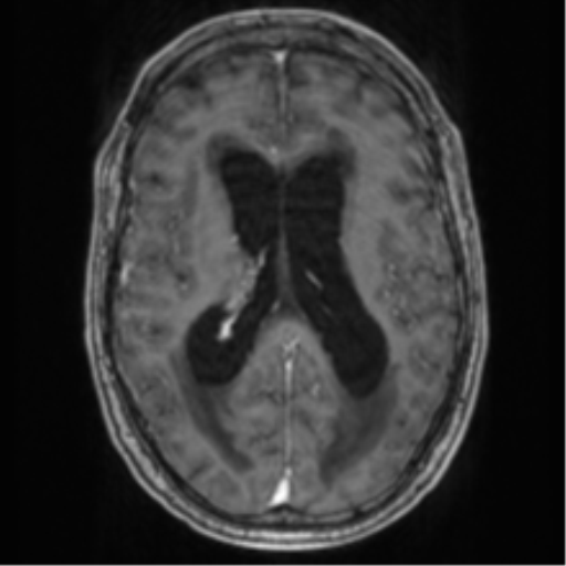 File:Cerebellar metastasis from lung adenocarcinoma (Radiopaedia 86690-102829 Axial T1 C+ 46).png