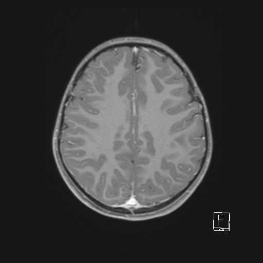 Cerebellar stroke (Radiopaedia 32202-33150 Axial T1 C+ 50).png