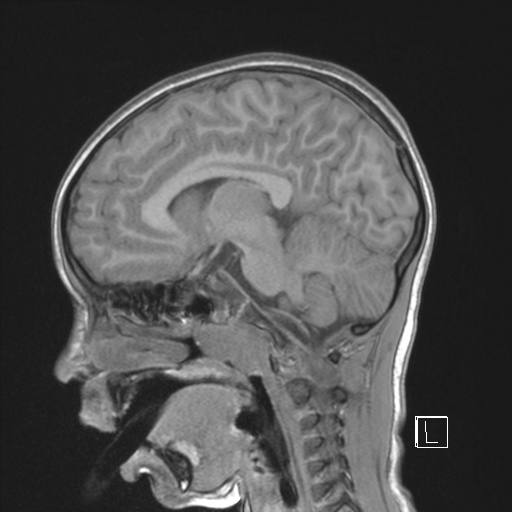 Cerebellar stroke (Radiopaedia 32202-33150 Sagittal T1 C+ 29).png