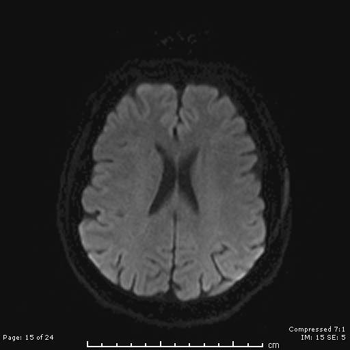 File:Cerebellar strokes due to intracranial giant cell arteritis (Radiopaedia 68799-81713 Axial DWI 15).jpg