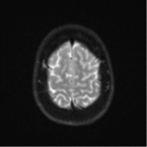 Cerebellar tuberculomas (Radiopaedia 46939-51472 Axial DWI 25).png