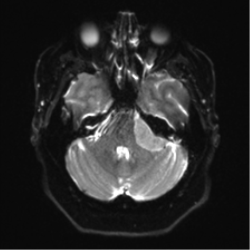 Cerebellopontine angle meningioma (Radiopaedia 48434-53348 Axial DWI 10).png