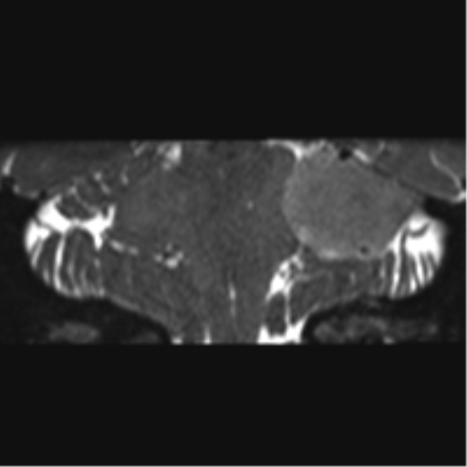 File:Cerebellopontine angle meningioma (Radiopaedia 48434-53348 Coronal T2 35).png