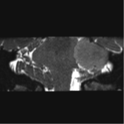 File:Cerebellopontine angle meningioma (Radiopaedia 48434-53348 Coronal T2 37).png