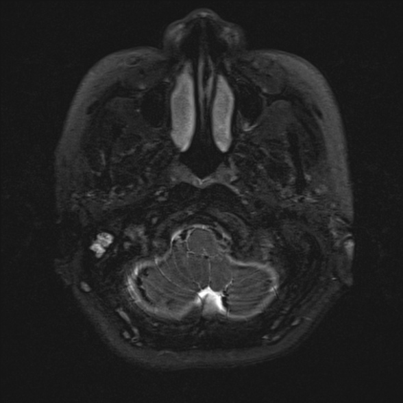 Cerebellopontine angle meningioma (Radiopaedia 53561-59591 Axial 3D volume T2 14).jpg