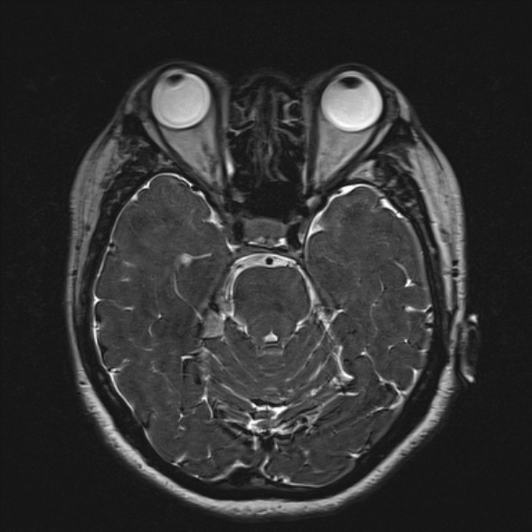 File:Cerebellopontine angle meningioma (Radiopaedia 53561-59591 Axial 3D volume T2 83).jpg