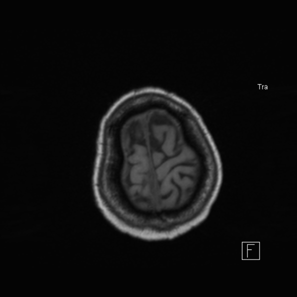 Cerebral abscess (Radiopaedia 26111-26247 Axial T1 49).jpg