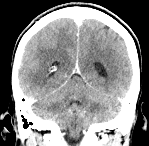 Cerebral abscess (Radiopaedia 60342-68008 Coronal C+ delayed 46).png