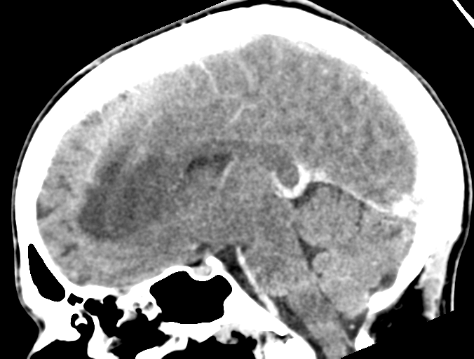 File:Cerebral abscess (Radiopaedia 60342-68008 Sagittal C+ delayed 26).png