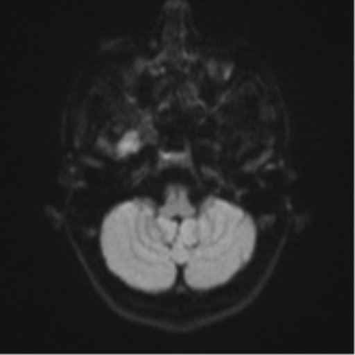 Cerebral abscess (Radiopaedia 60342-68009 Axial DWI 42).png