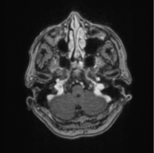 Cerebral abscess from pulmonary arteriovenous malformation (Radiopaedia 86275-102291 Axial T1 C+ 15).png