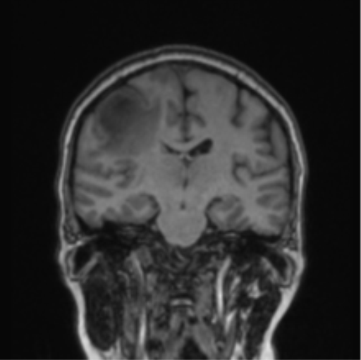 File:Cerebral abscess from pulmonary arteriovenous malformation (Radiopaedia 86275-102291 Coronal T1 44).png