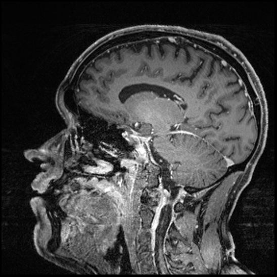 Cerebral abscess with ventriculitis (Radiopaedia 78965-91878 Sagittal T1 C+ 106).jpg