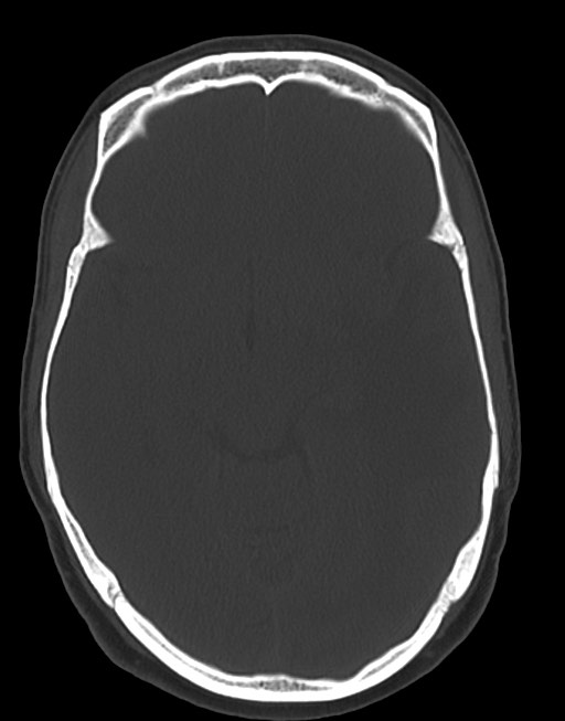 Cerebral abscesses (Radiopaedia 70458-80568 Axial bone window 28).jpg
