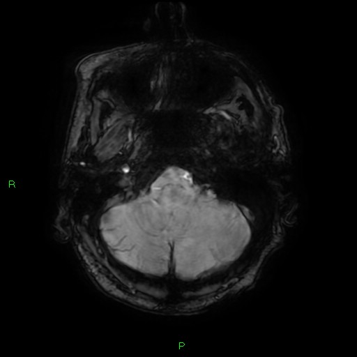 File:Cerebral amyloid angiopathy-associated lobar intracerebral hemorrhage (Radiopaedia 58376-65512 Axial SWI 9).jpg