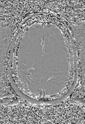 File:Cerebral amyloid angiopathy (Radiopaedia 29129-29518 Axial SWI Phase 31).jpg