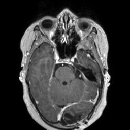 Cerebral amyloid angiopathy (Radiopaedia 29129-29518 Axial T1 C+ 50).jpg