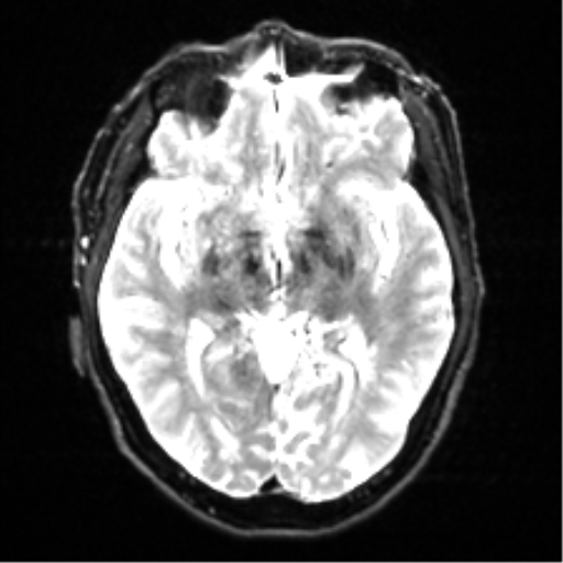 Cerebral amyloid angiopathy (Radiopaedia 46082-50433 Axial DWI 12).png