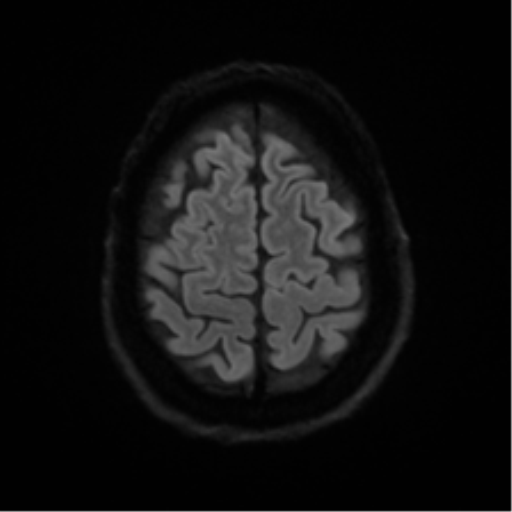 Cerebral amyloid angiopathy (Radiopaedia 46082-50433 Axial DWI 50).png