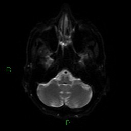 Cerebral amyloid angiopathy (Radiopaedia 77506-89664 Axial DWI 35).jpg