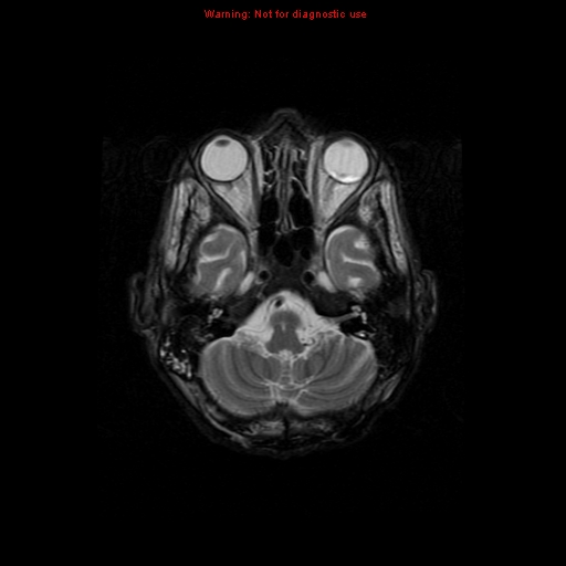 File:Cerebral and orbital tuberculomas (Radiopaedia 13308-13311 Axial T2 5).jpg