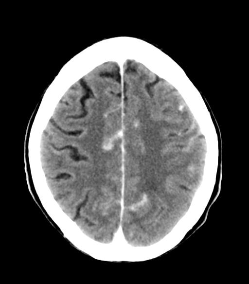 File:Cerebral aneurysm with rupture (Radiopaedia 29933-30460 Axial non-contrast 20).jpg