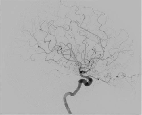 File:Cerebral angiographic projections (Radiopaedia 46308-50712 F 1).jpg
