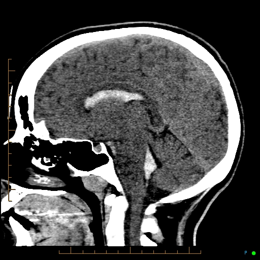 Cerebral arteriovenous malformation (AVM) (Radiopaedia 78162-90706 A 39).jpg