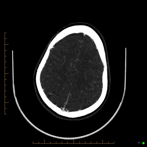 Cerebral arteriovenous malformation (AVM) (Radiopaedia 78162-90706 Axial CTA 215).jpg