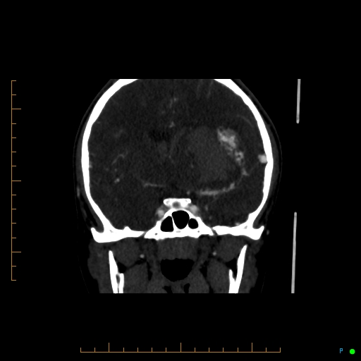 Cerebral arteriovenous malformation (AVM) (Radiopaedia 78162-90706 Coronal CTA 59).jpg