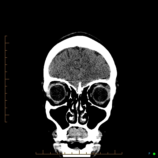 Cerebral arteriovenous malformation (AVM) (Radiopaedia 78162-90706 Coronal non-contrast 18).jpg