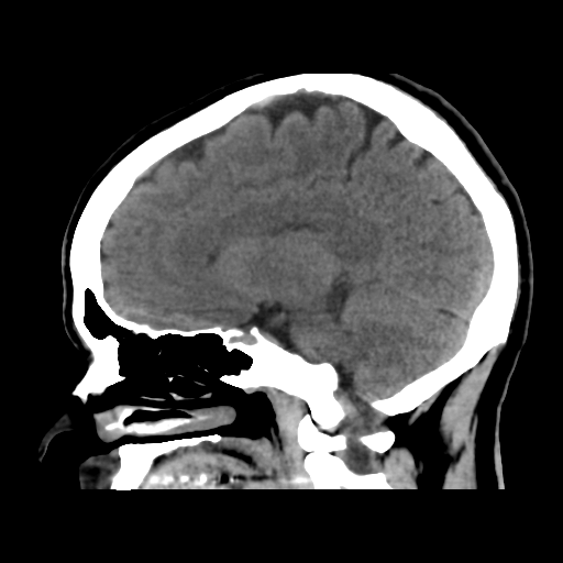 File:Cerebral arteriovenous malformation (Radiopaedia 39259-41505 B 21).png