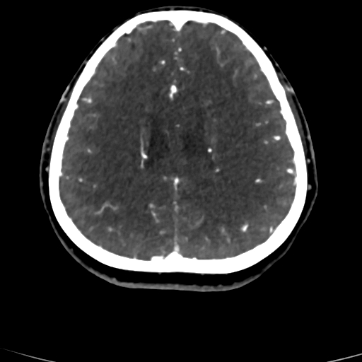 Cerebral arteriovenous malformation (Radiopaedia 73830-84645 Axial C+ delayed 31).jpg