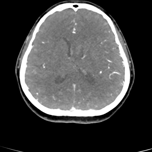 File:Cerebral arteriovenous malformation (Radiopaedia 73830-84645 B 44).jpg