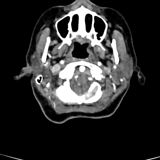 Cerebral arteriovenous malformation (Radiopaedia 73830-84645 B 93).jpg