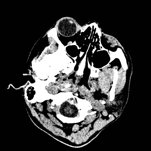 Cerebral arteriovenous malformation (Radiopaedia 79677-92887 Axial non-contrast 1).jpg
