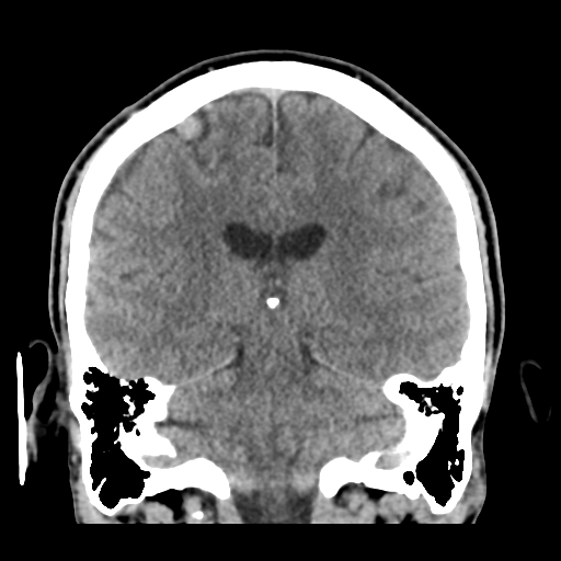 Cerebral arteriovenous malformation (Spetzler-Martin grade 2) (Radiopaedia 41262-44076 Coronal non-contrast 38).png