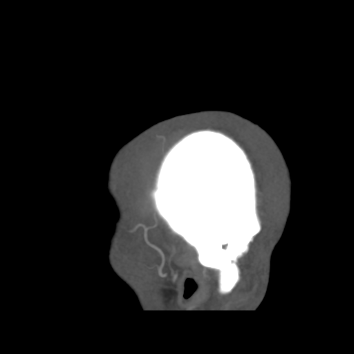 Cerebral arteriovenous malformation (Spetzler-Martin grade 2) (Radiopaedia 41262-44076 G 52).png