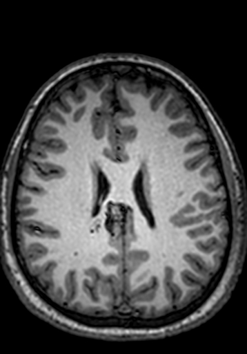 Cerebral arteriovenous malformation at posterior body of corpus callosum (Radiopaedia 74111-84925 Axial T1 101).jpg