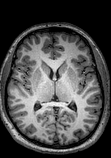 Cerebral arteriovenous malformation at posterior body of corpus callosum (Radiopaedia 74111-84925 Axial T1 140).jpg