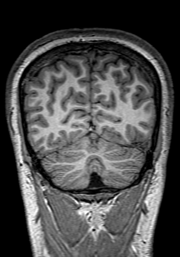 File:Cerebral arteriovenous malformation at posterior body of corpus callosum (Radiopaedia 74111-84925 Coronal T1 285).jpg