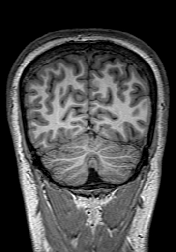 Cerebral arteriovenous malformation at posterior body of corpus callosum (Radiopaedia 74111-84925 Coronal T1 288).jpg