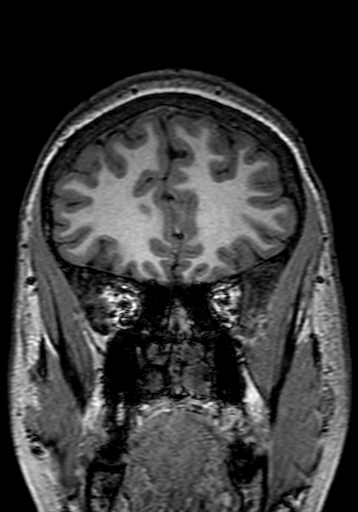 Cerebral arteriovenous malformation at posterior body of corpus callosum (Radiopaedia 74111-84925 Coronal T1 63).jpg