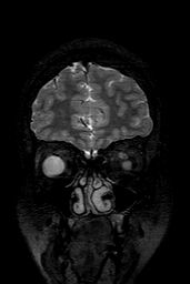 Cerebral arteriovenous malformation at posterior body of corpus callosum (Radiopaedia 74111-84925 Coronal T2 25).jpg