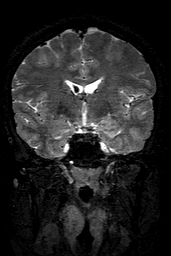 Cerebral arteriovenous malformation at posterior body of corpus callosum (Radiopaedia 74111-84925 Coronal T2 79).jpg